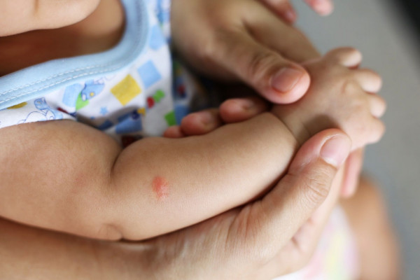 Gigitan nyamuk pada bayi